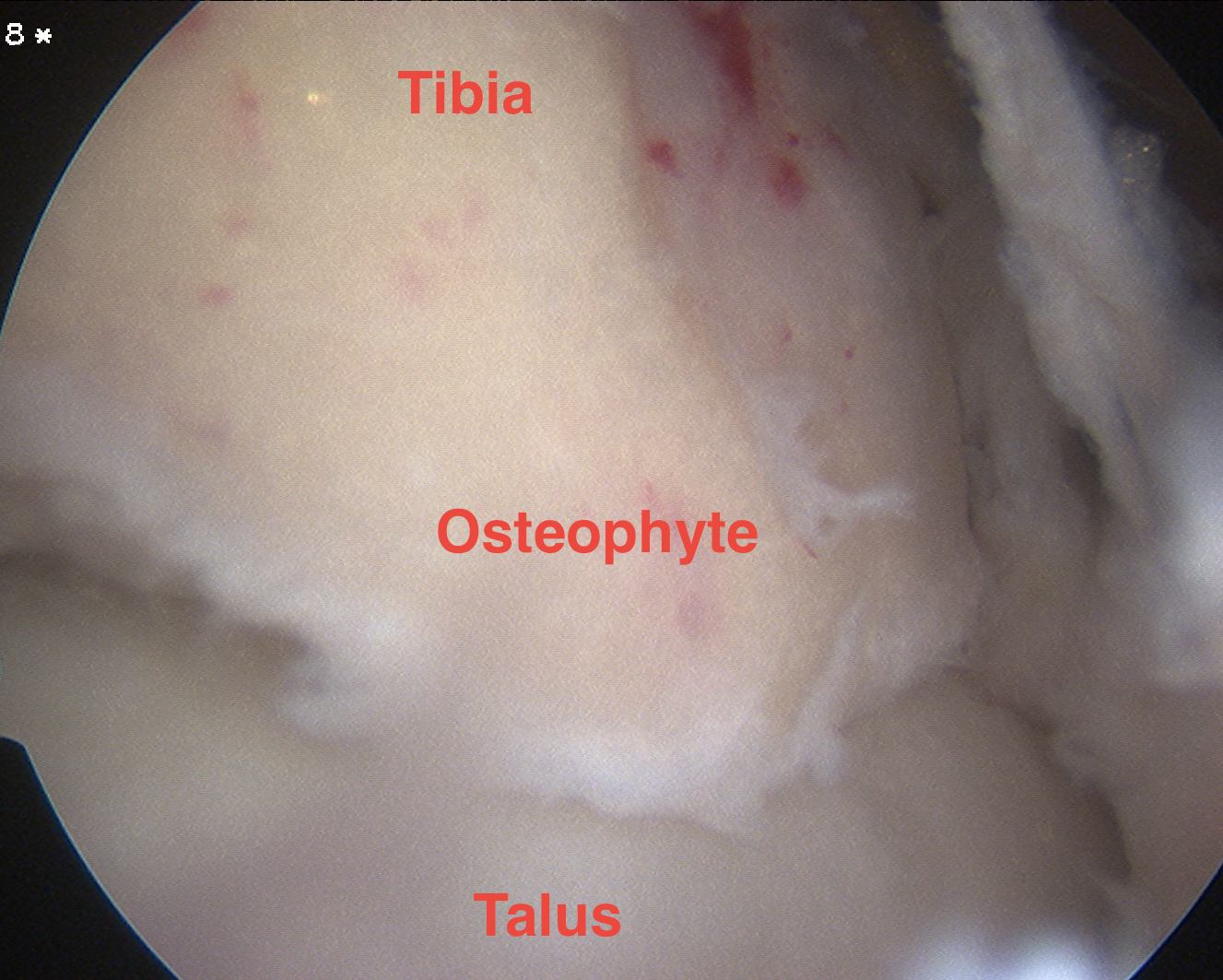 Ankle Scope Anterior Tibial Osteophyte